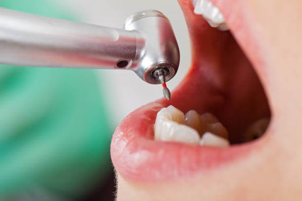 Best Emergency Wisdom Teeth Removal in Bartlesville, OK